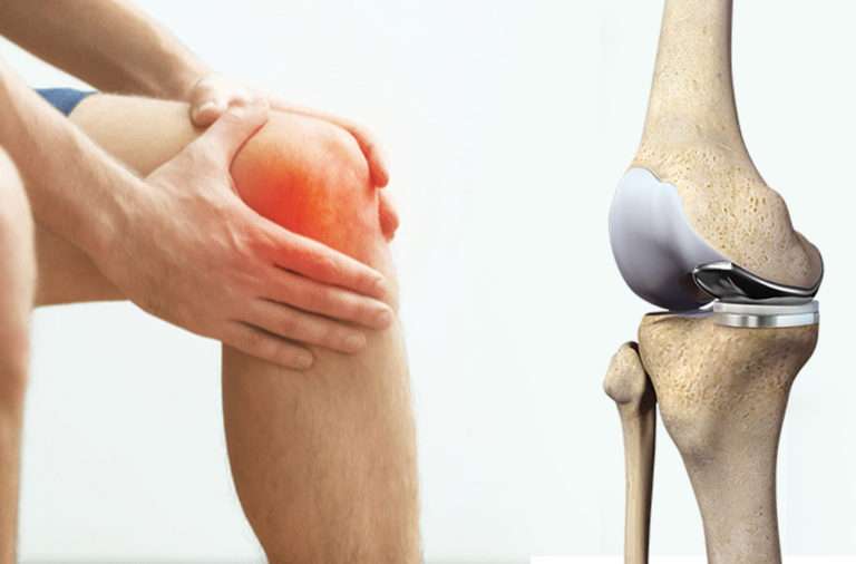 Partial Knee Replacement Can Also Treat Your Pain