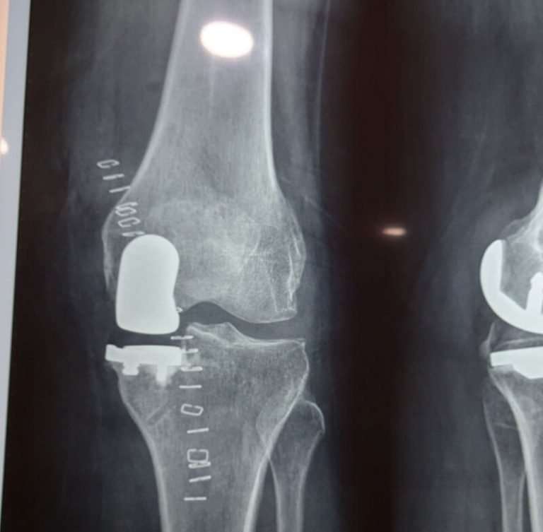 Partial Knee Replacement  Dr. Ashit Shah