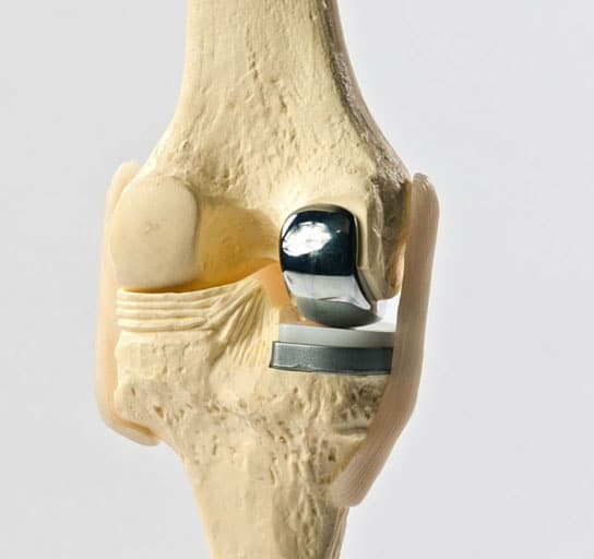 PARTIAL KNEE REPLACEMENT  Senior Orthopedic and Joint Replacement Surgeon