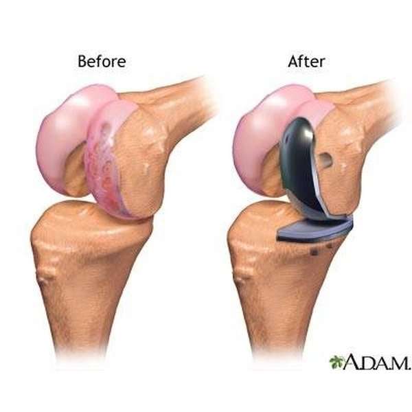 Partial Knee Replacement Surgery