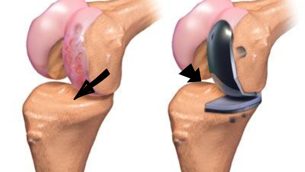 Partial knee replacement surgery information you must have!