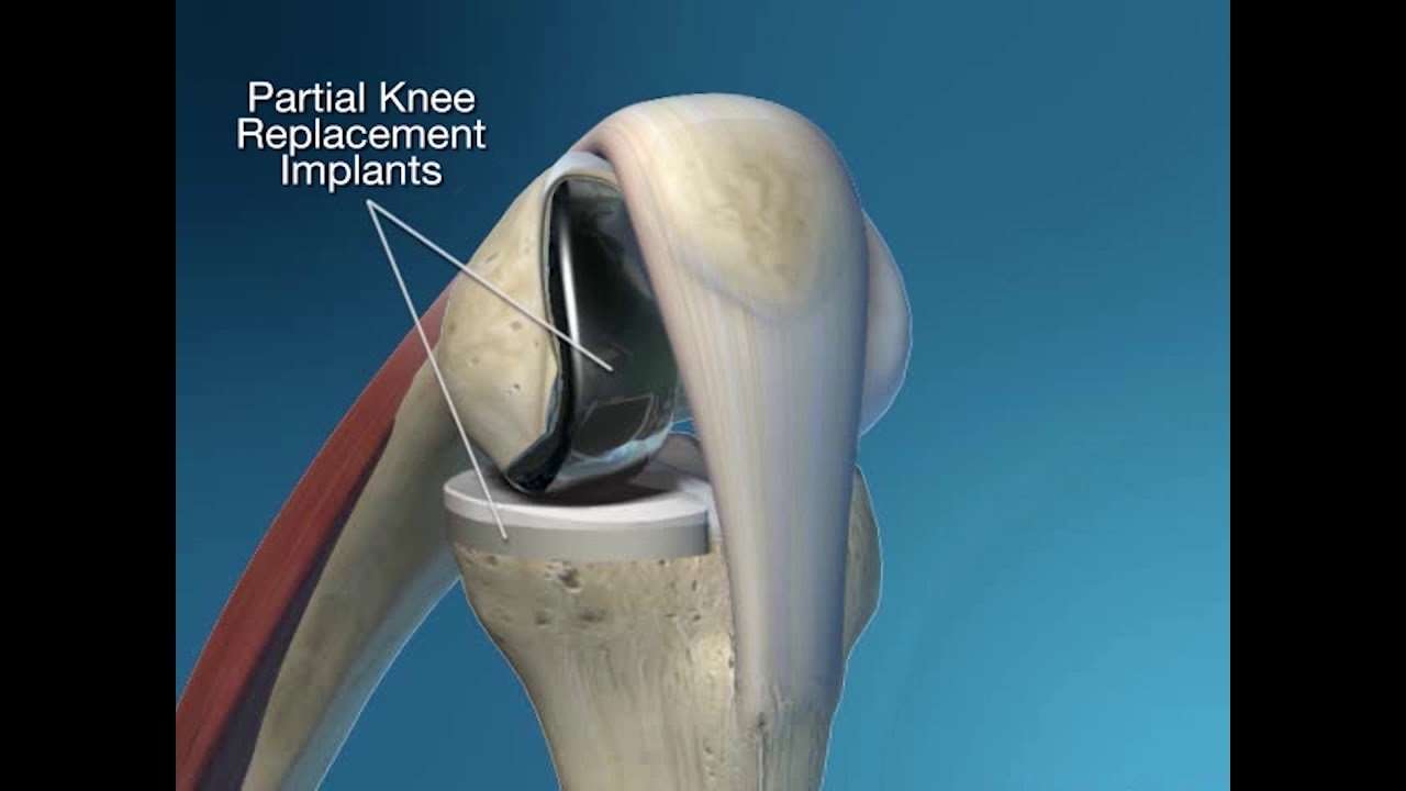 Partial Knee Replacement