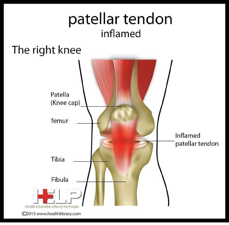 Patellar Tendon Inflamed, tendonitis
