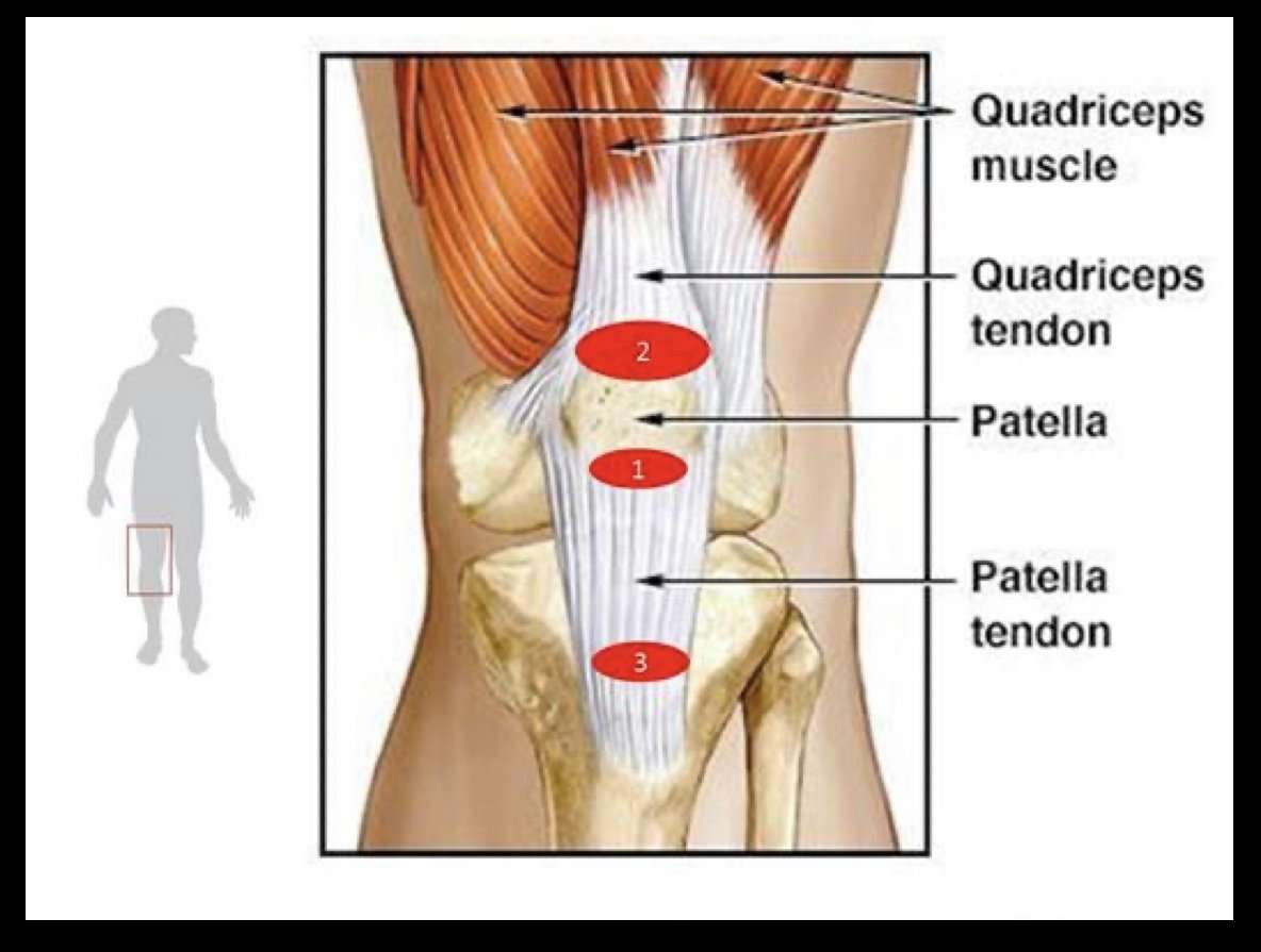 Patellar tendonitis: Jumpers knee â Get Well Physical Therapy