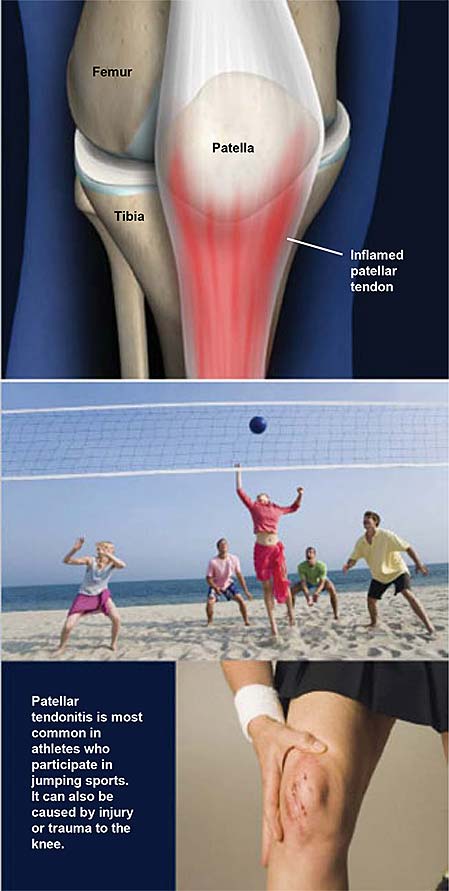 Patellar Tendonitis (Jumpers Knee)