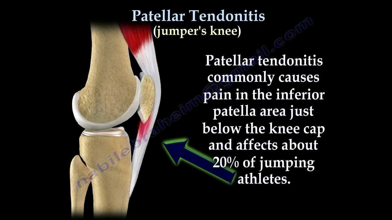Patellar Tendonitis Jumper