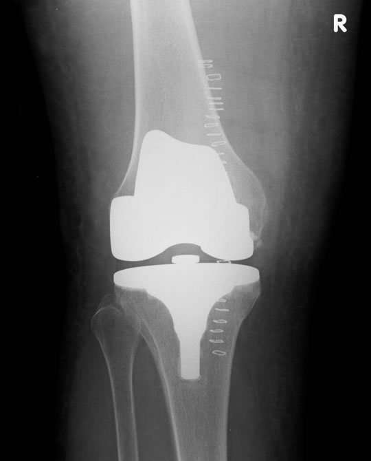 Patellofemoral Kneecap Replacement Surgery