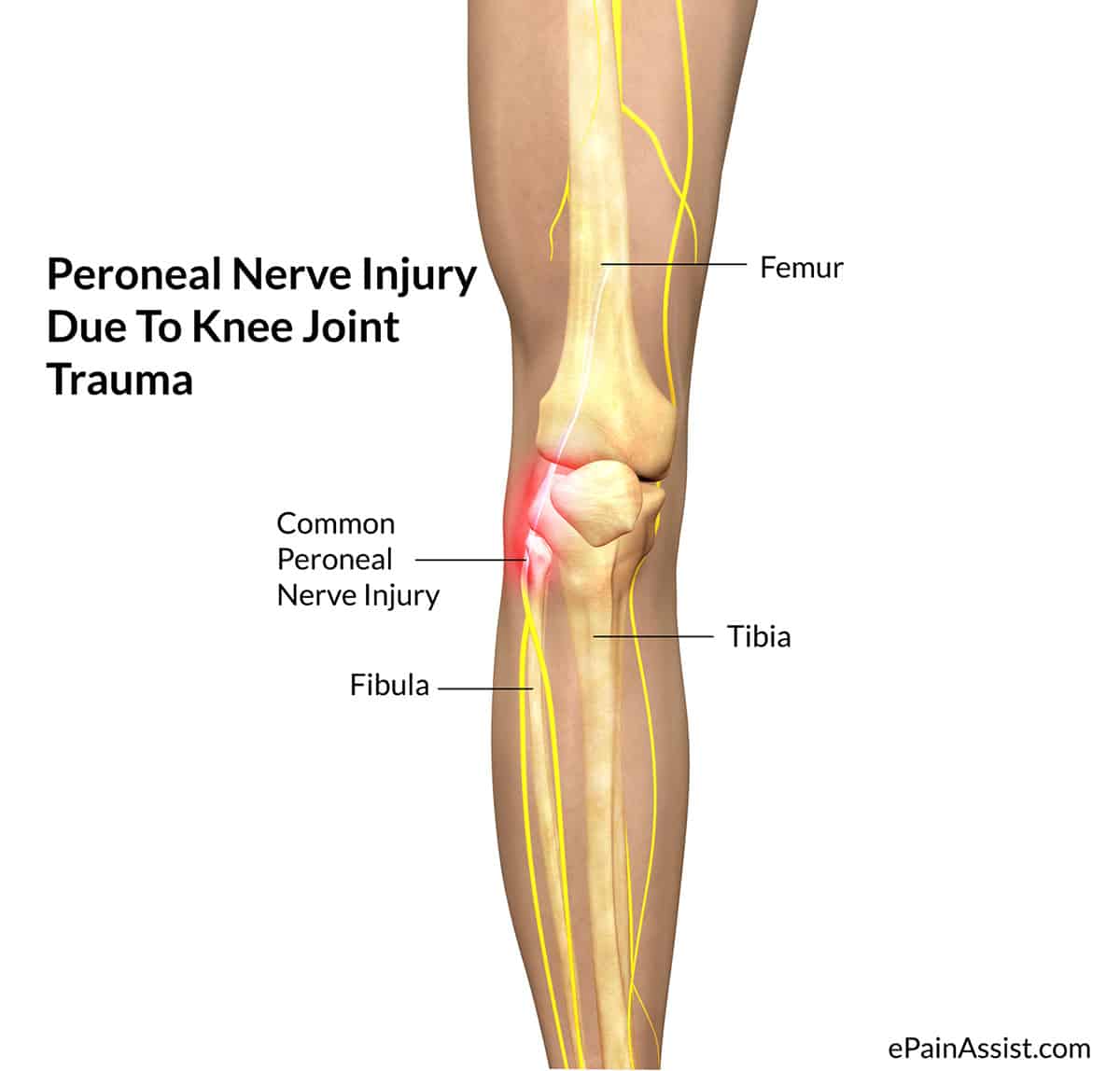 Peroneal Nerve Injury