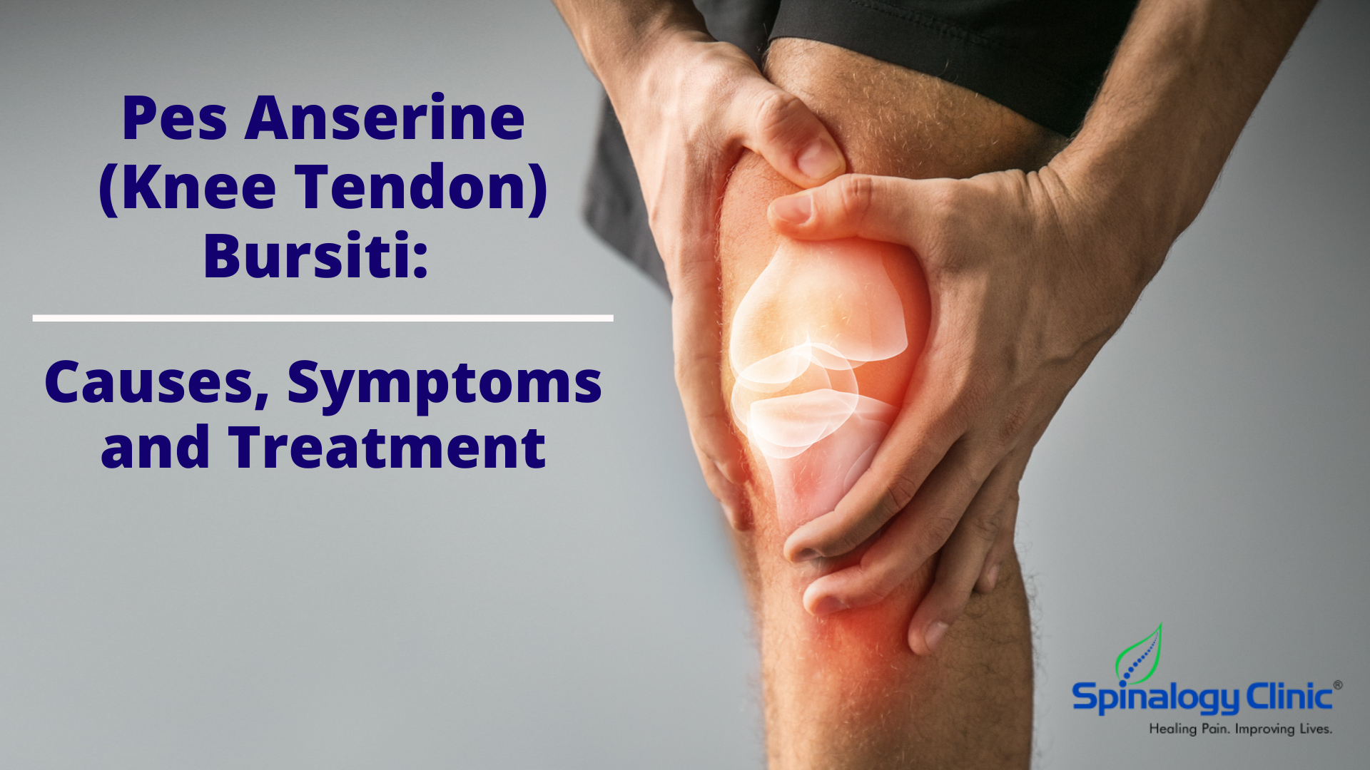 Pes Anserine (Knee Tendon) Bursiti: Causes, Symptoms and ...
