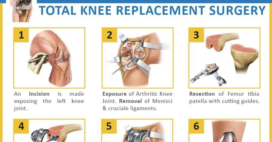 Physio Knowledge : Total Knee Replacement Rehabilitation