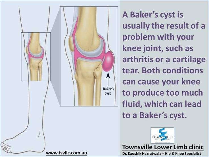 Pin on Bakerâs Cyst of The Knee