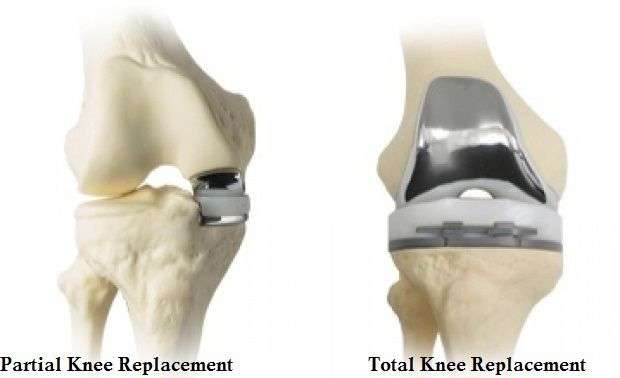 Pin on Cost of Knee Replacement Surgery in India