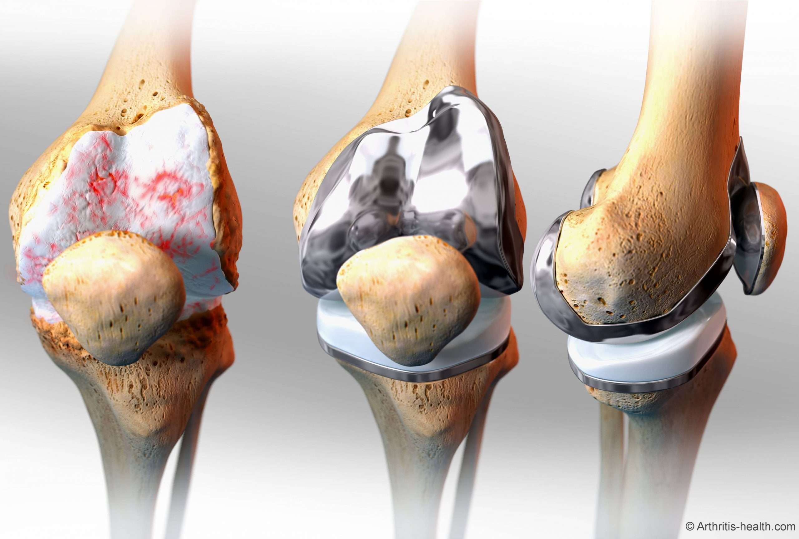 Pin on Knee replacement