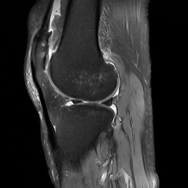 Pixel Degenerative joint disease of the knee joint with mucoid ...