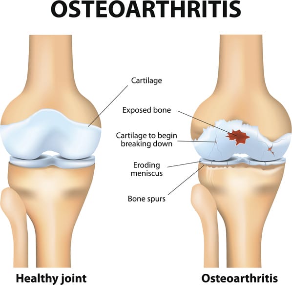 Popping Joints Associated With Knee Osteoarthritis