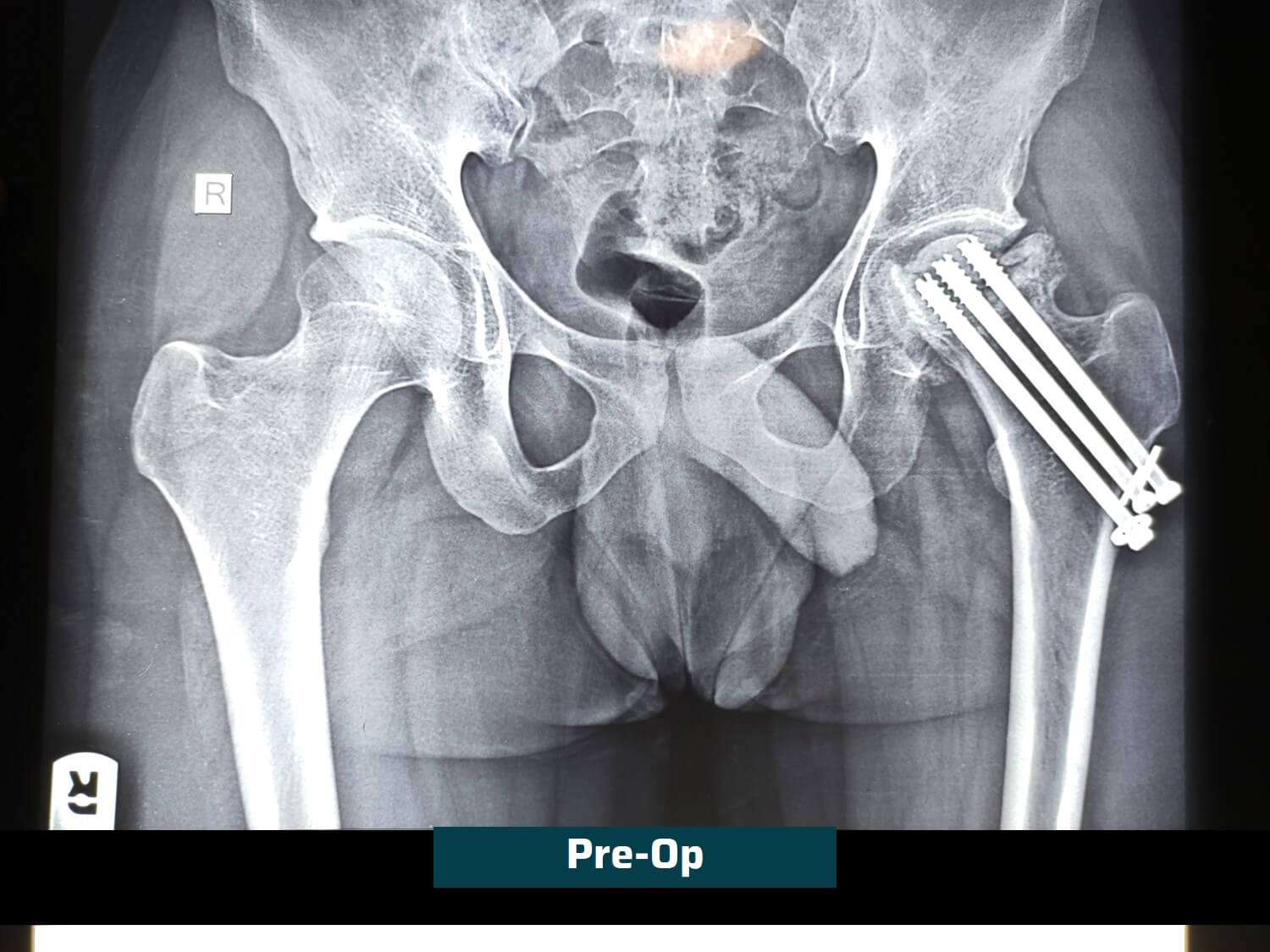 Primary Hip Replacement Surgery Ahmedabad
