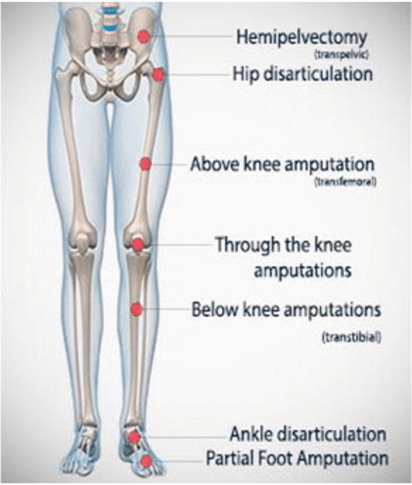 Prosthetics for Lower Limb Amputation