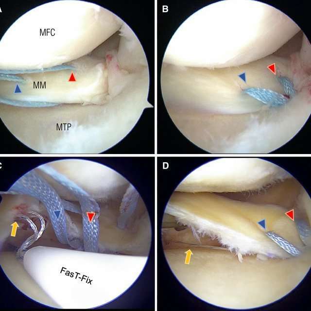 Pullout repair of the medial meniscus posterior root tear ...