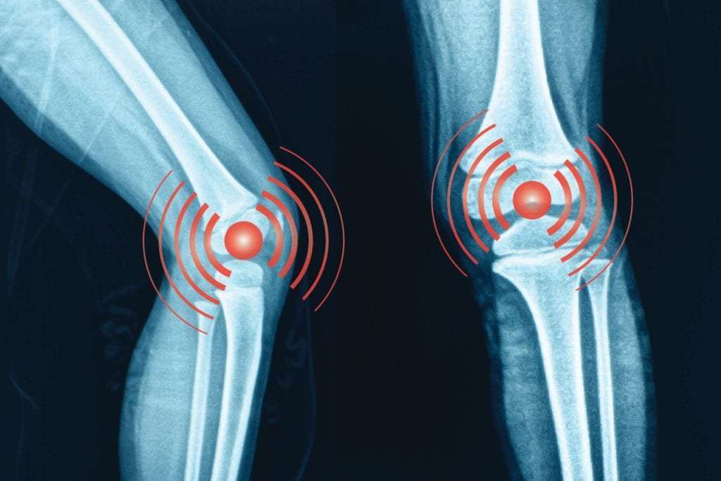 Radiographic Knee Osteoarthritis Increases Risk of Early Death