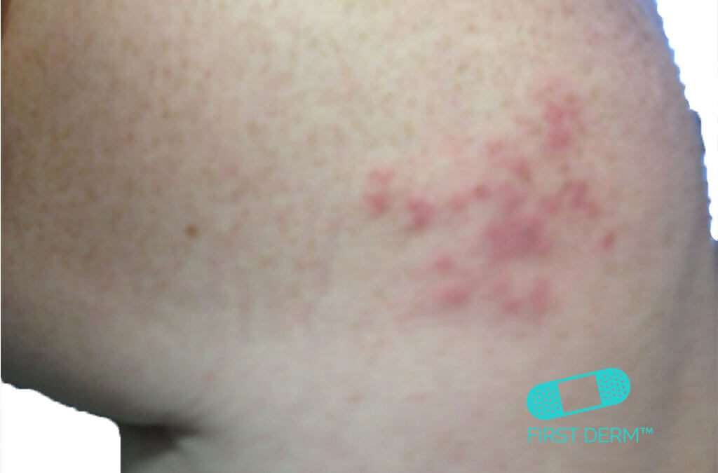Red spots on skin: Pictures, causes, treatment