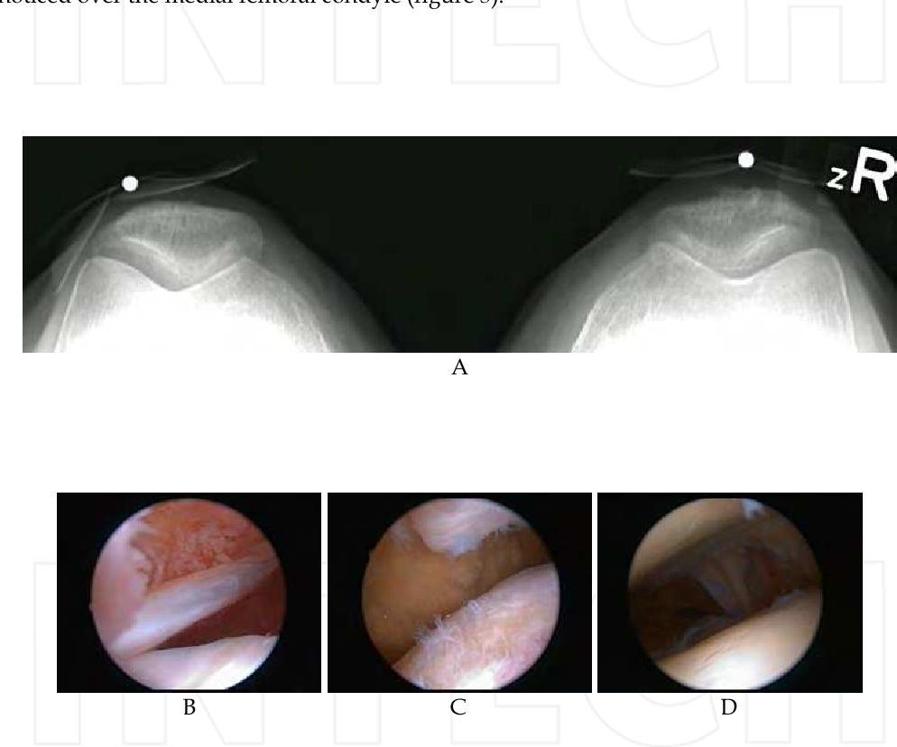 Regenerate Knee Cartilage