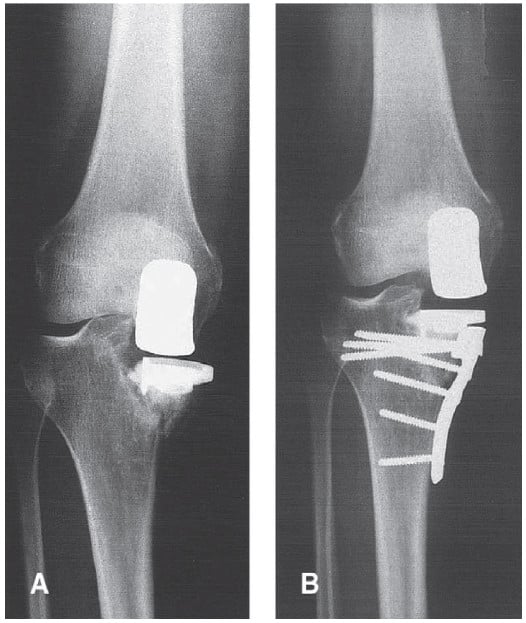 Resurgence of Unicompartmental Knee Arthroplasty