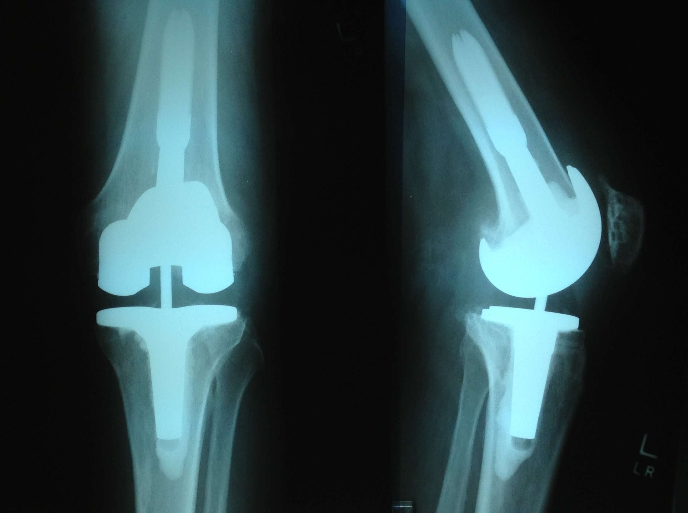 Revision Total Knee Replacement Dr. Stuart Kozinn, MD ...