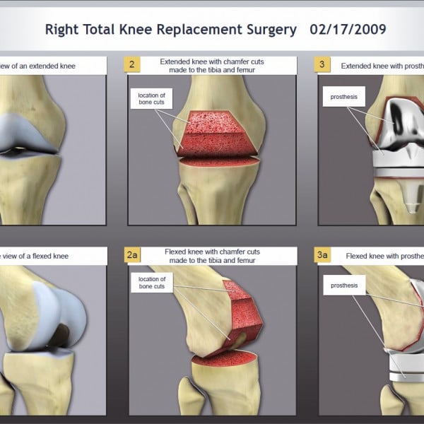 Right Total Knee Replacement Surgery