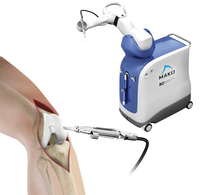 Robotic Assisted Knee Surgery Cincinnati