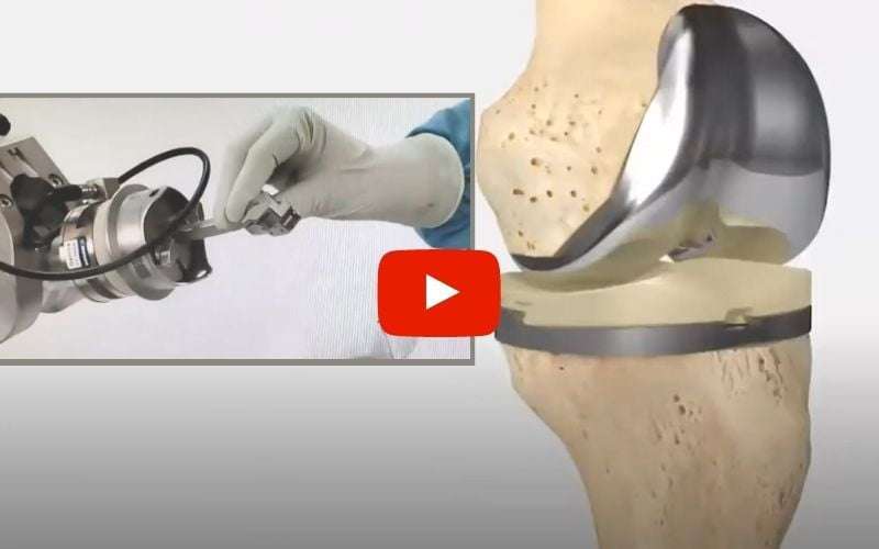 Robotic Knee Replacement: Everything you need to know ...