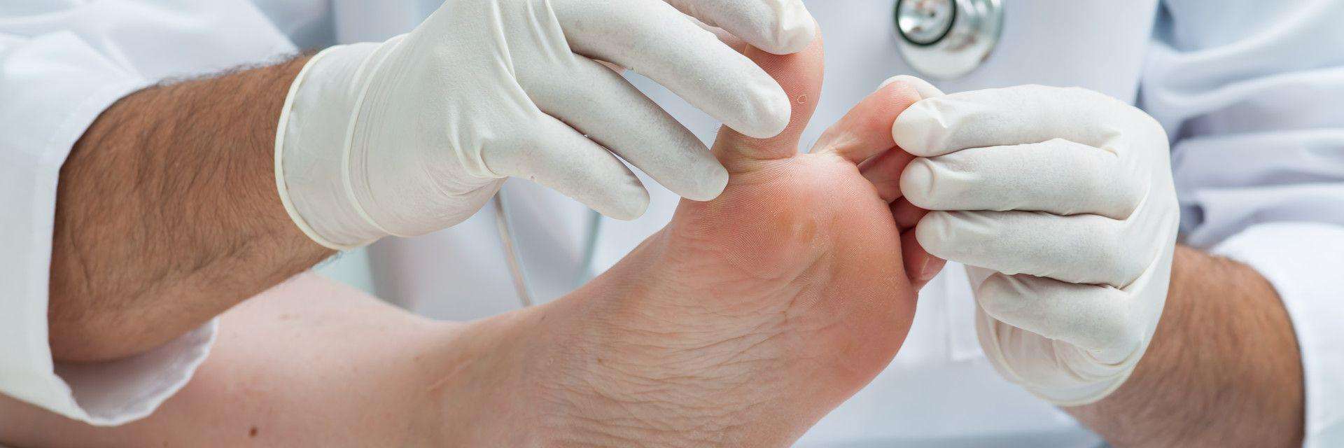 Rothman Orthopaedic Institute Provides The Best Toe Nail Fungus ...