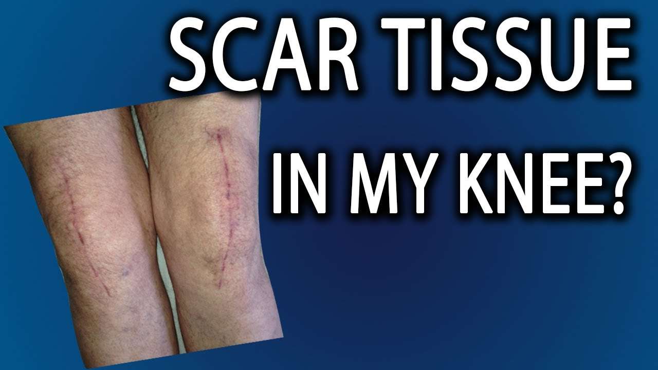 Scar Tissue In Knee: How Do I Get Rid Of It