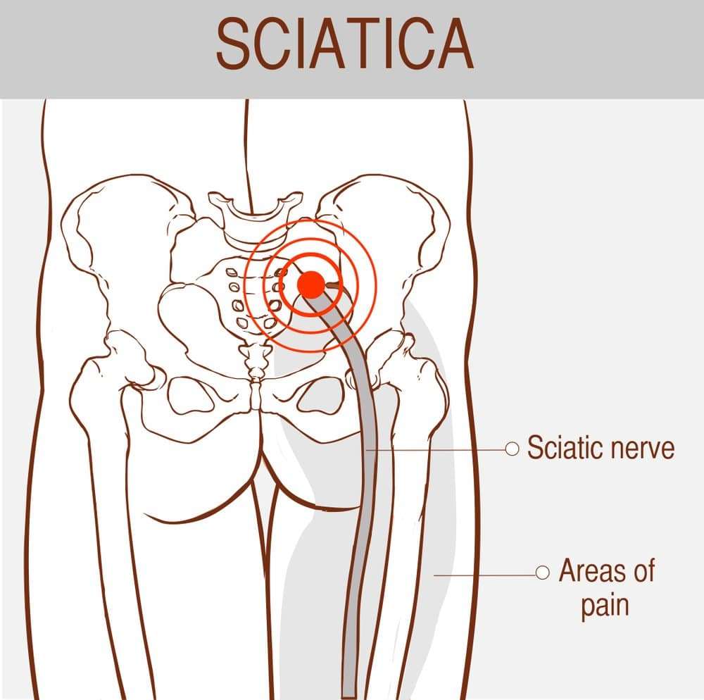 Sciatic Nerve Pain After Knee Replacement