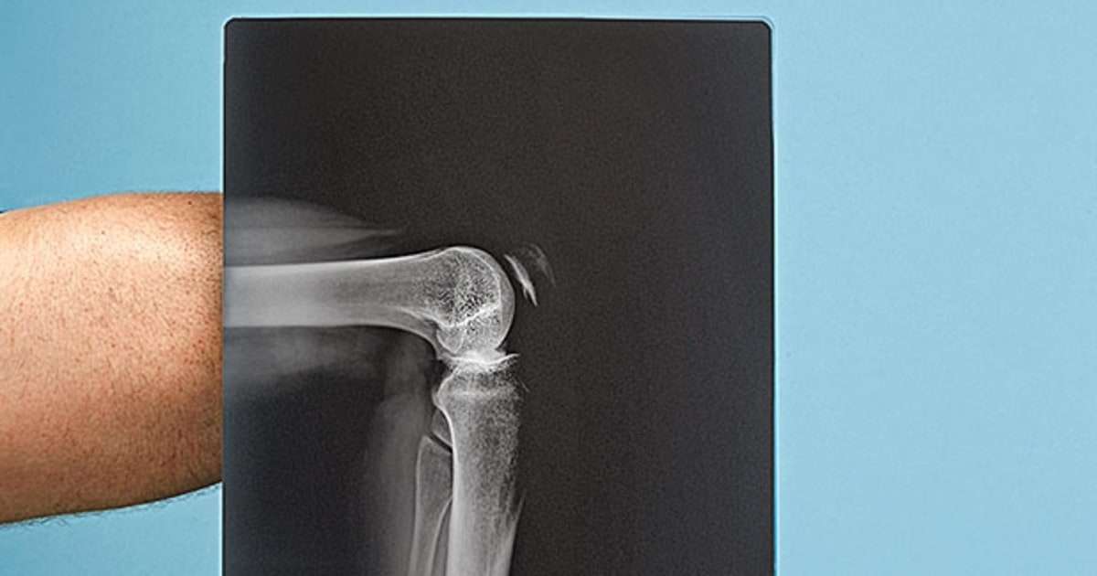 Second Opinion: Do I Really Need Knee Surgery?