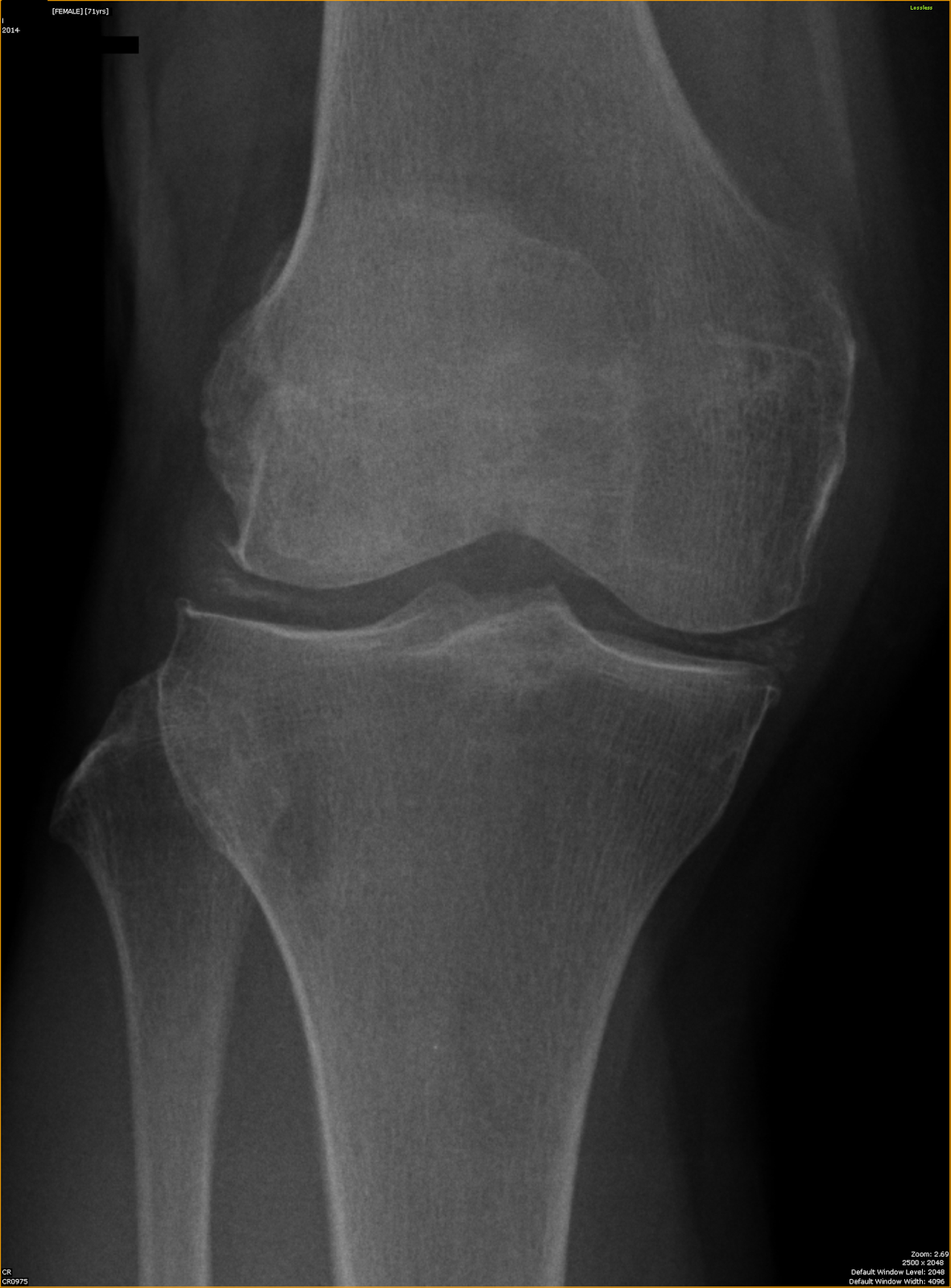 ShareMyRadiology æ¾å°çº¿å¦: Chondrocalcinosis of knee