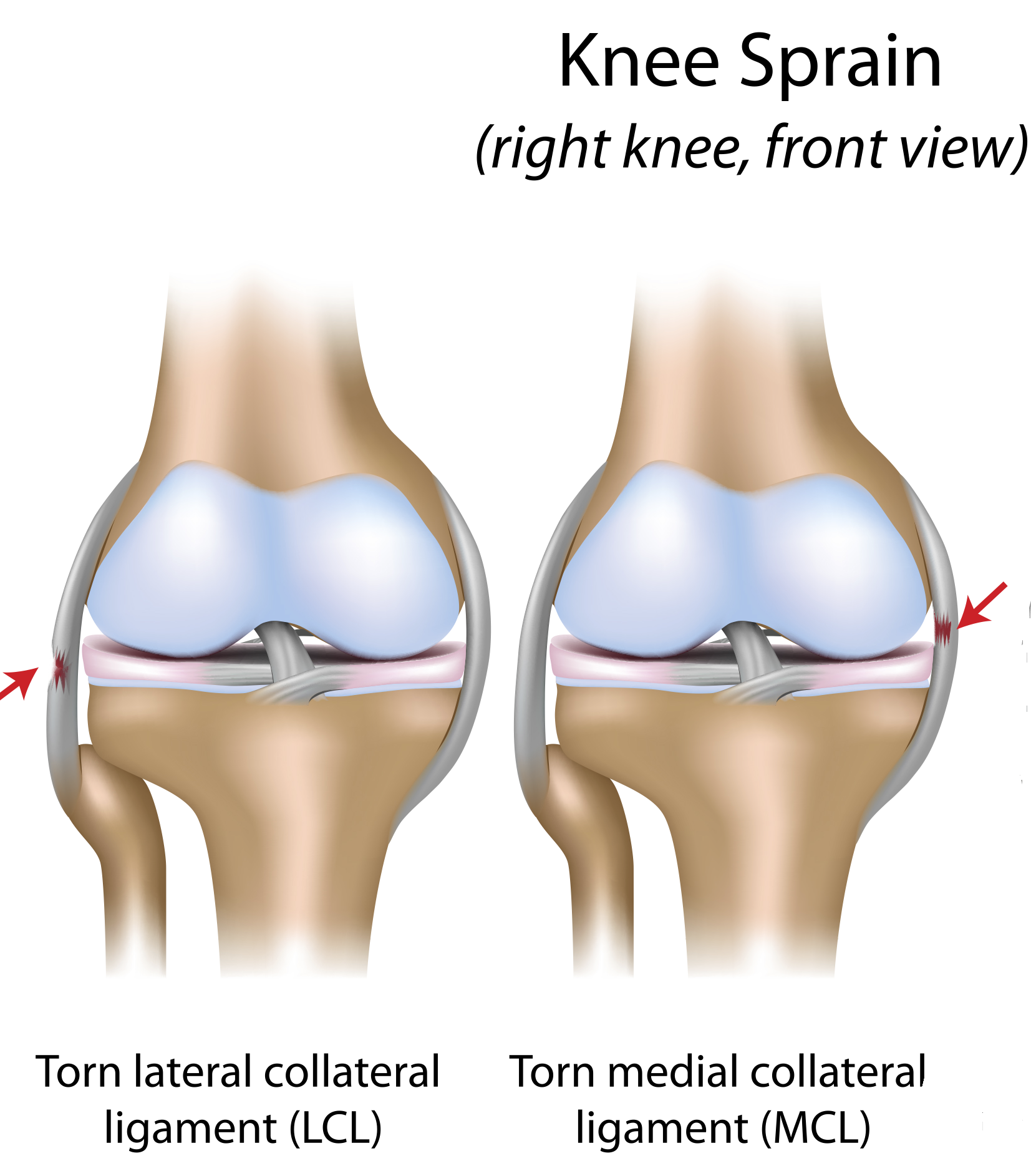 Sprained knee