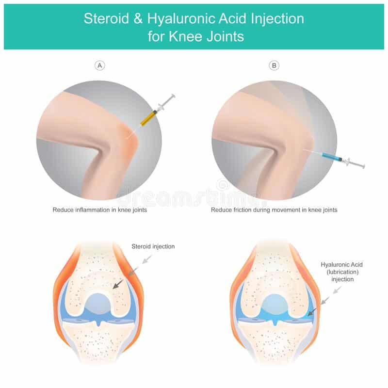 Steroid &  Hyaluronic Acid Injection for Knee Joints. Illustration ...