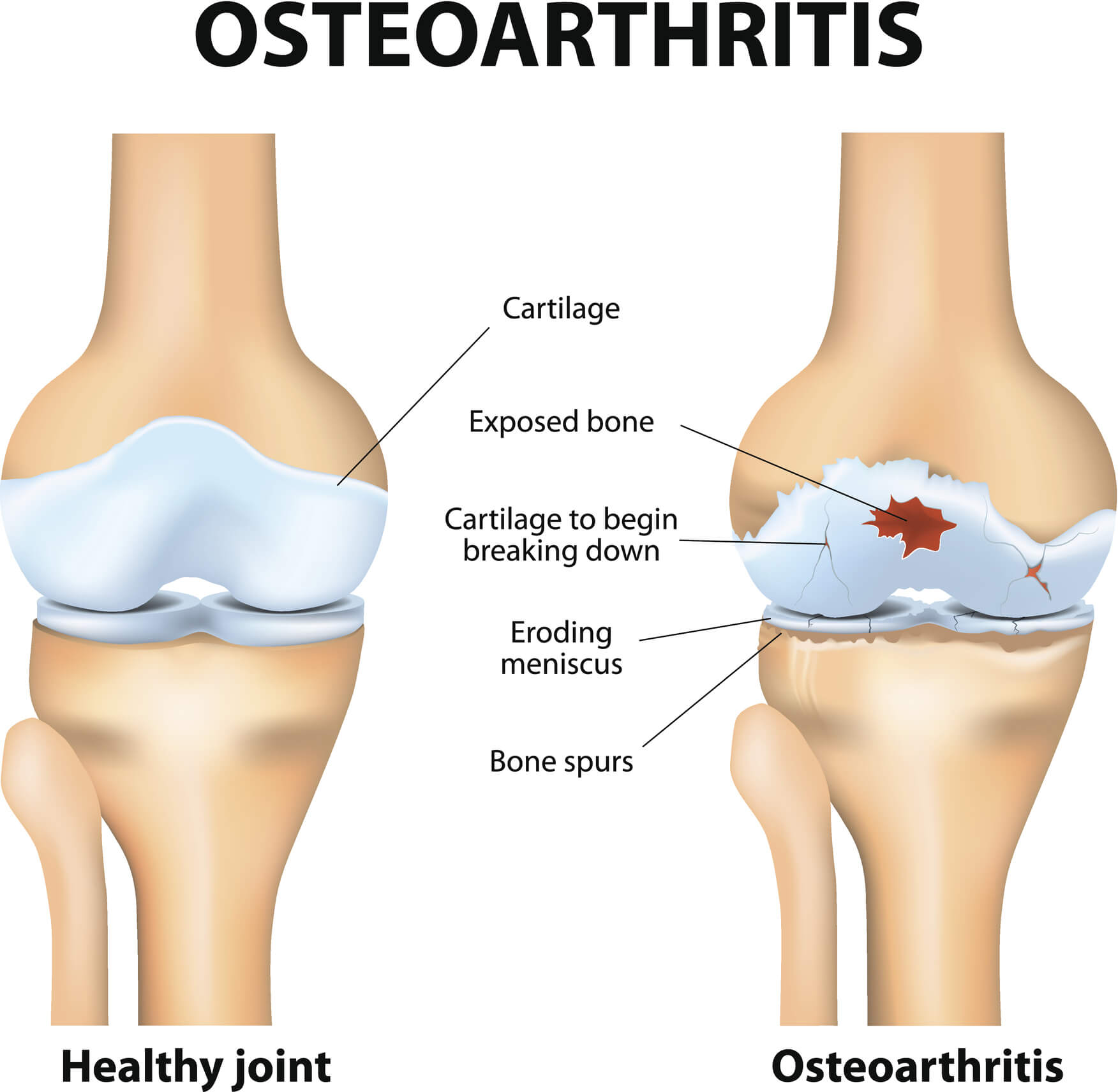 Stop and Reverse Osteoarthritis by Following These 2 Simple Tips