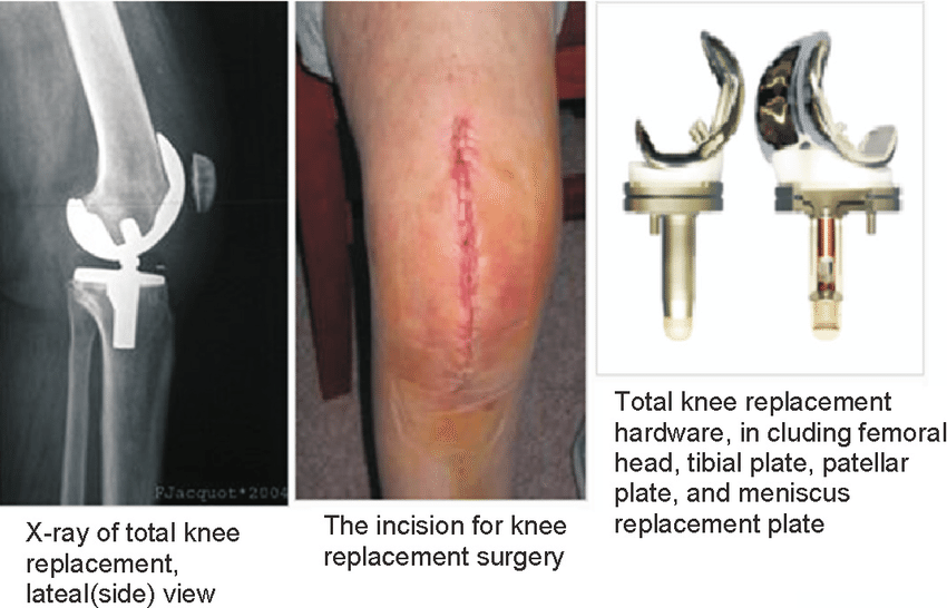 Surgical procedure of total knee replacement