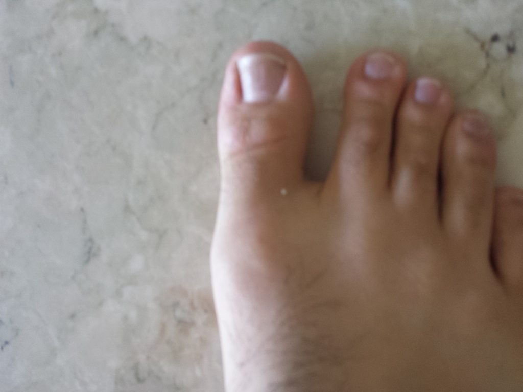 Swelling in my big toe joint. Does it look like gout? : gout