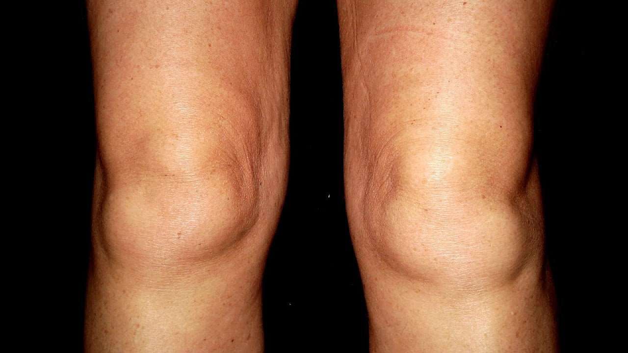 Swollen Behind The Knee
