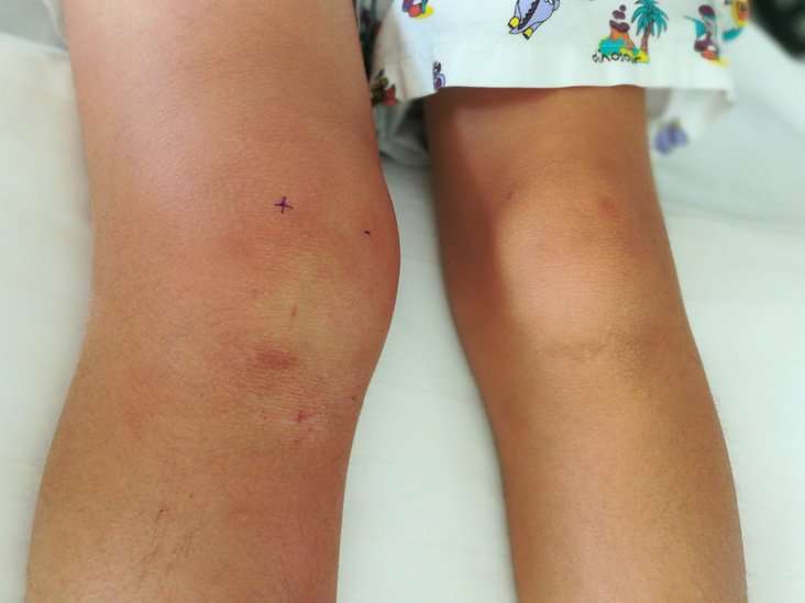 Swollen knee: Causes, treatments, and home remedies