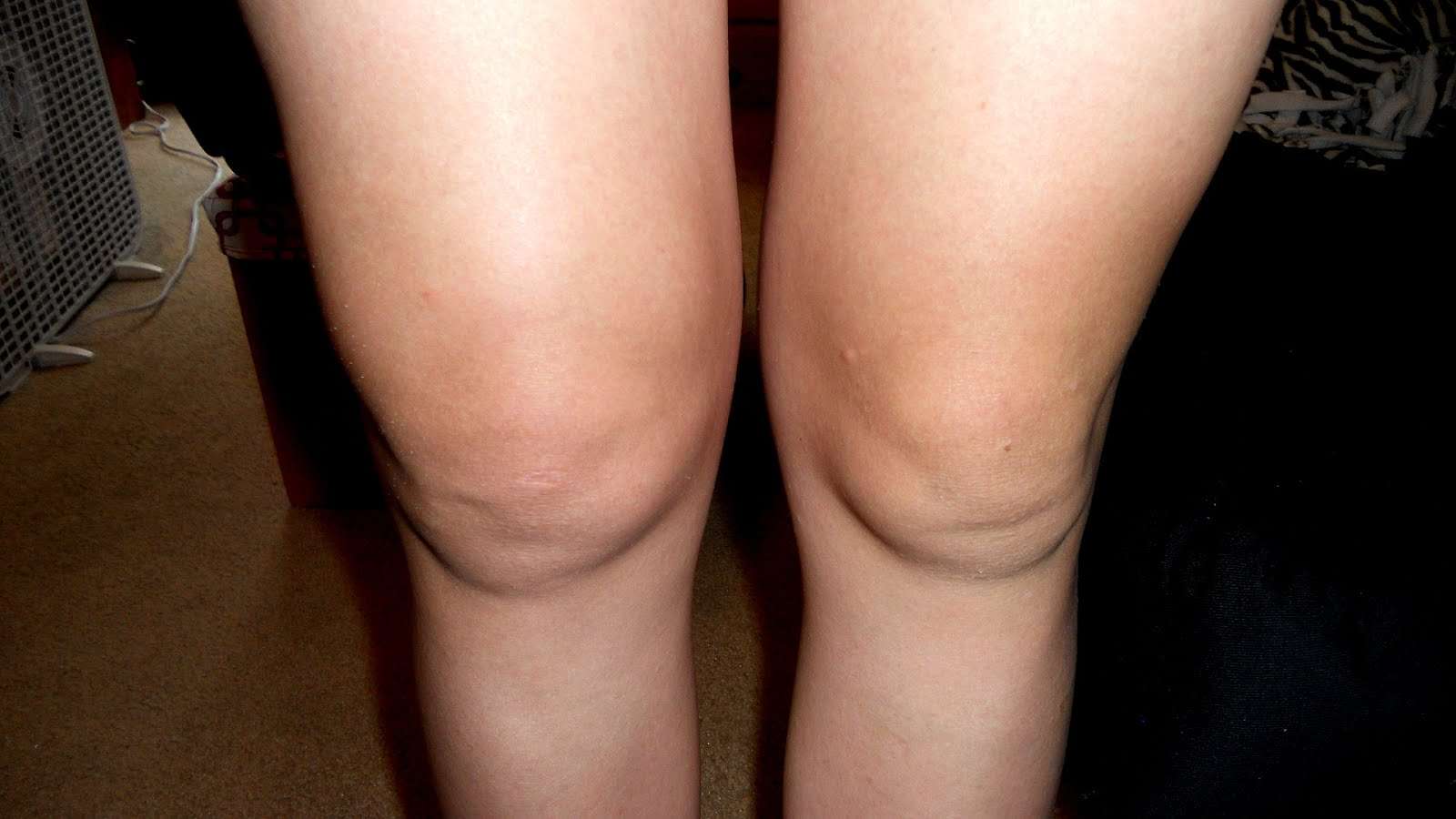Swollen Right Knee Cause
