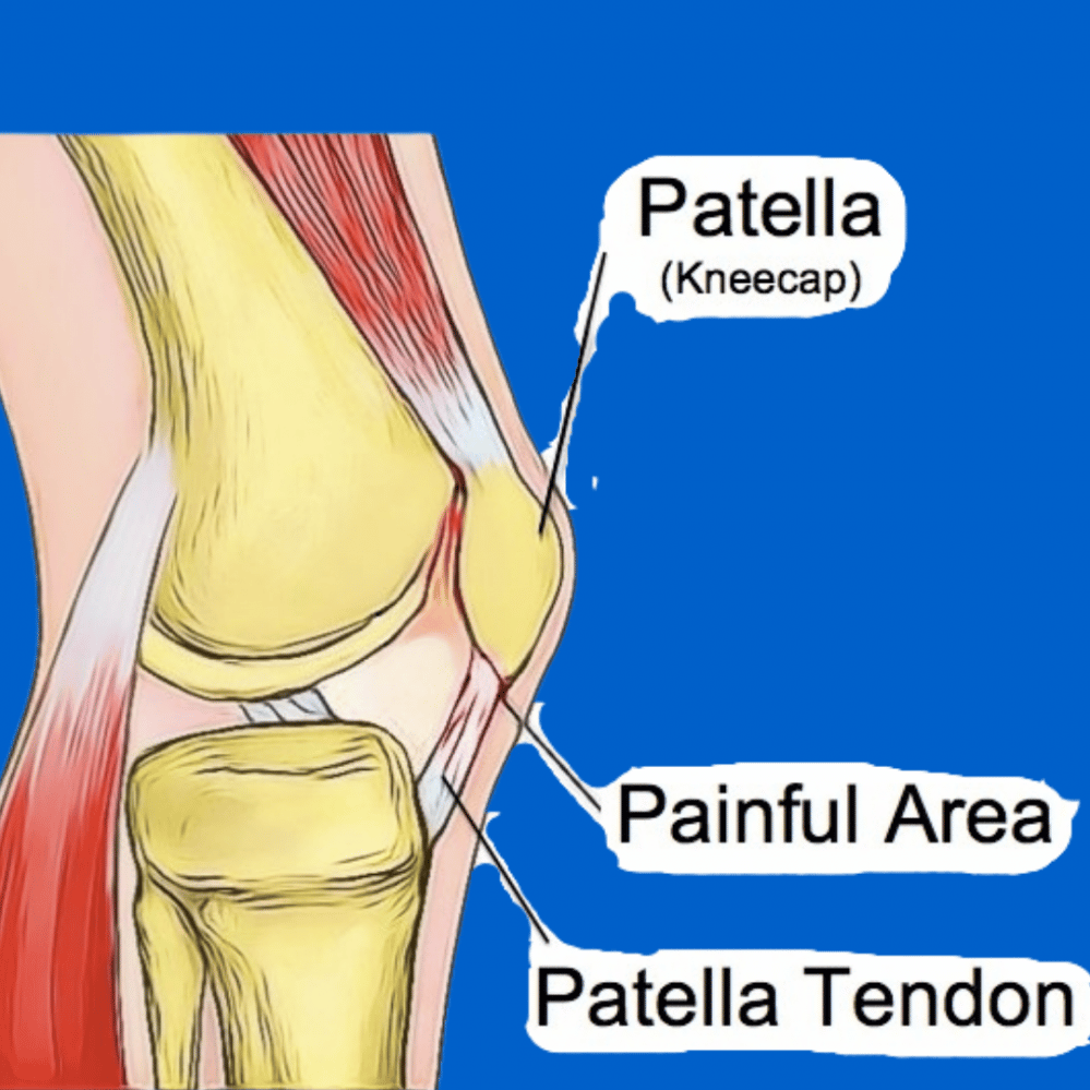 Tendinitis Knee Pain