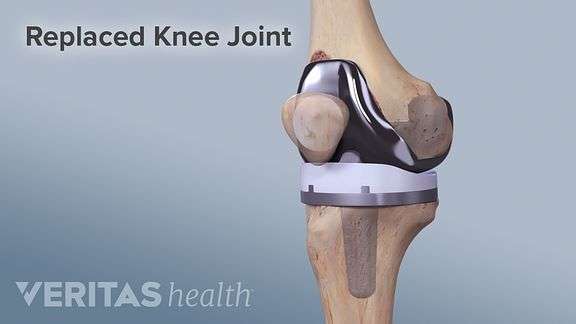 The Benefits of Losing Weight Before Knee Replacement