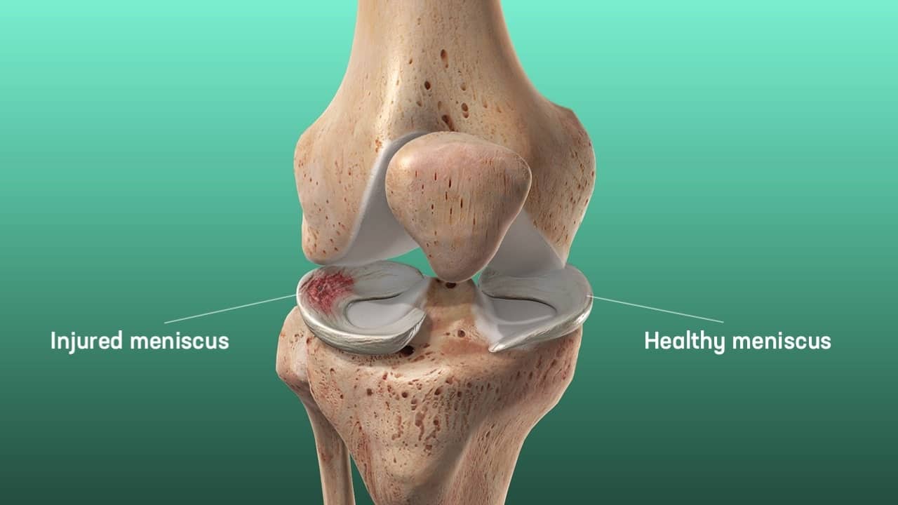 The Complete Guide to a Meniscus Tear
