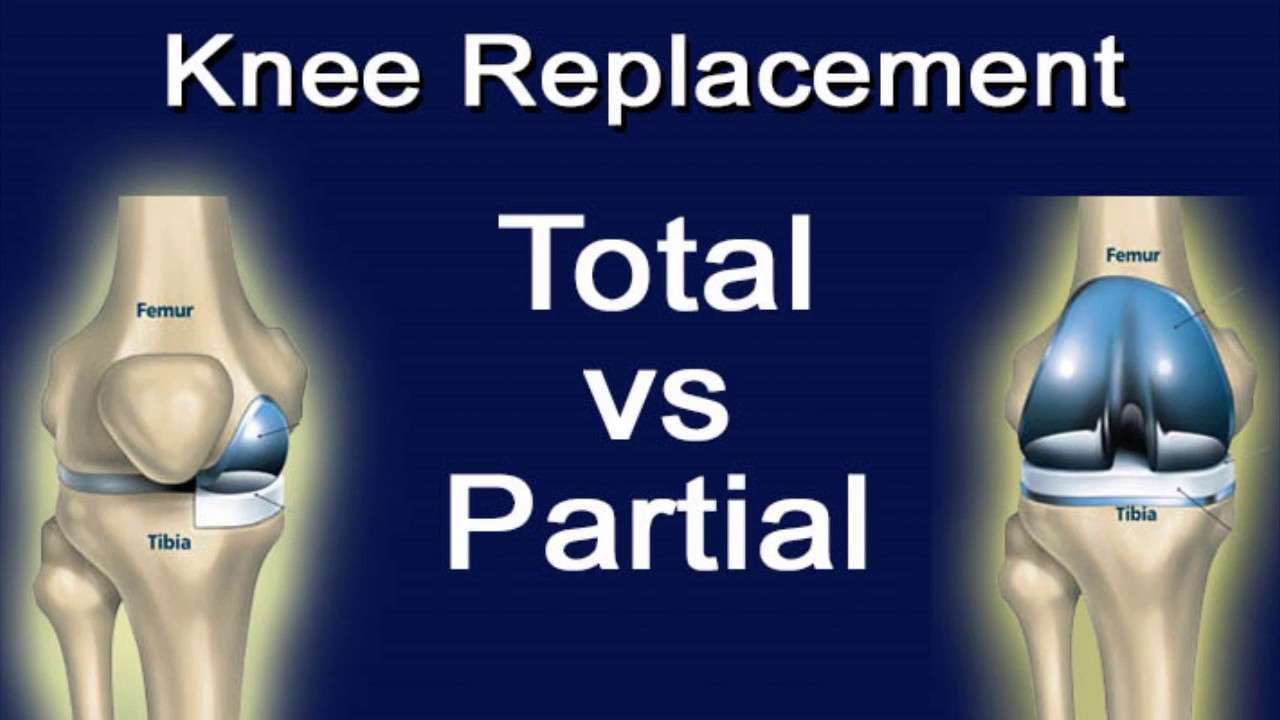 The Difference Between Total Knee Replacement And Partial ...
