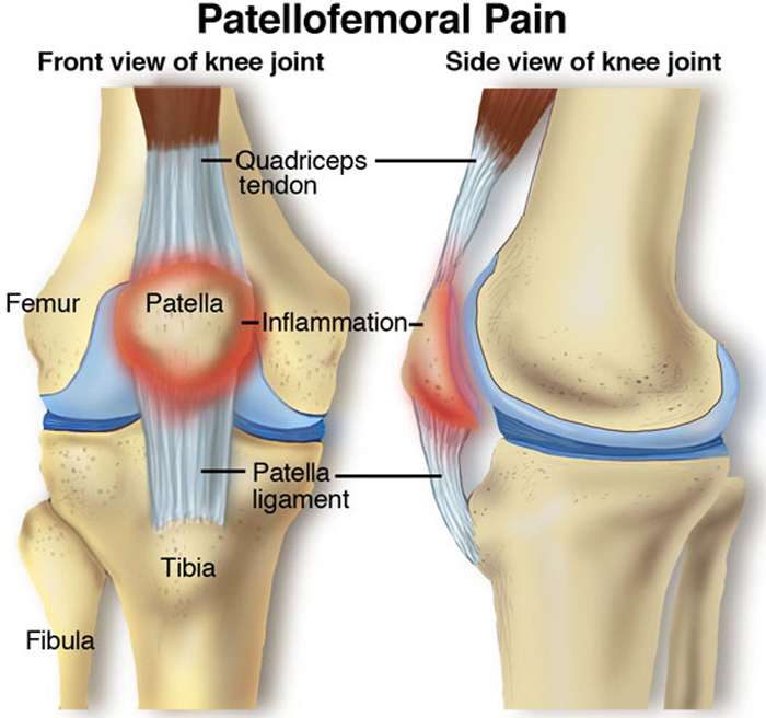 The Most Common Cause of Knee Pain