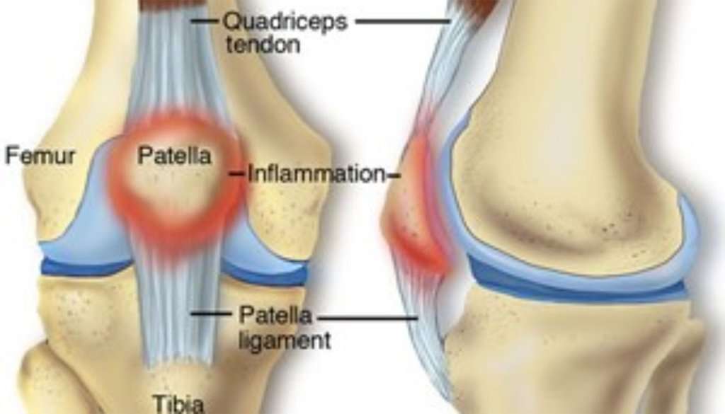 The Most Common Cause of Knee Pain  Roar Physiotherapy