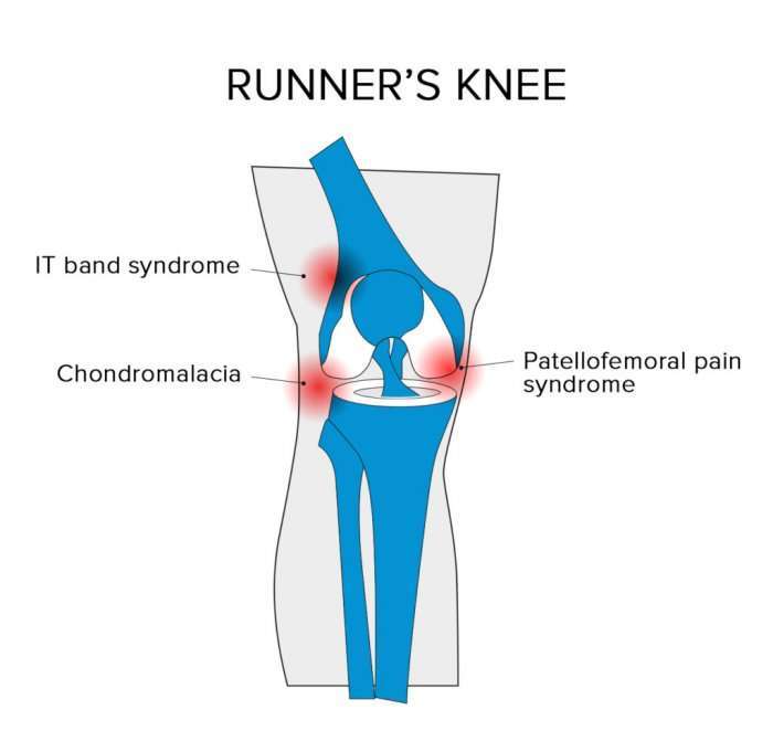The Most Common Running Pain and Injuries: Causes ...